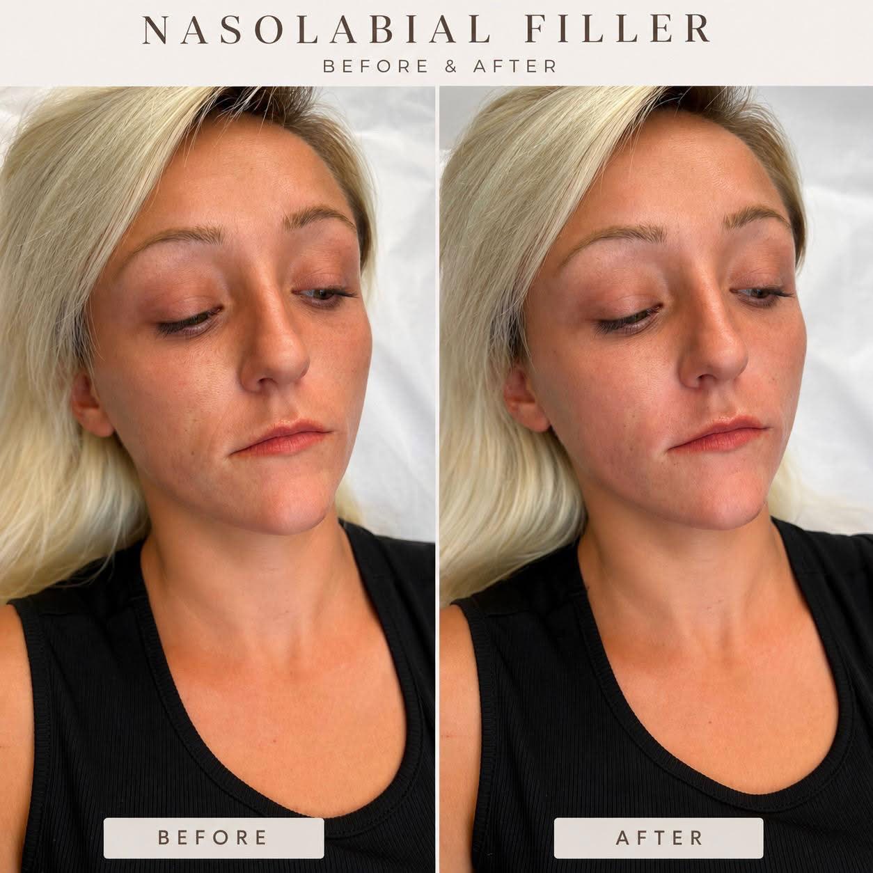 Nasolabial filler before and after supplied by SK:N SKULPT